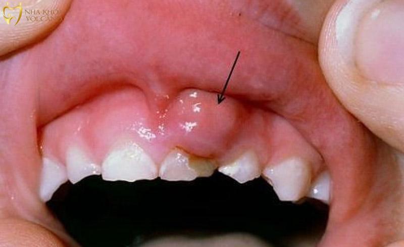 Cách điều trị sưng nướu răng có mủ Cách điều trị sưng nướu răng có mủ