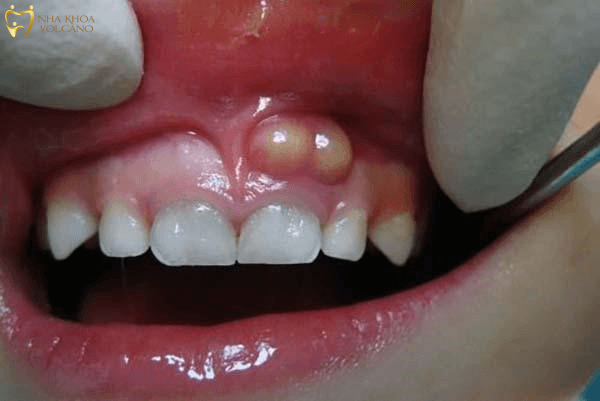 Sưng nướu răng có nguy hiểm không? Sưng nướu răng có nguy hiểm không?