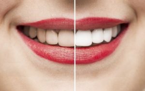 Tẩy trắng răng có bị vàng lại không? Lời khuyên từ bác sĩ bác sĩ
