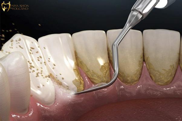 Việc lấy cao răng định kỳ giúp ngăn chặn sự hình thành của vết ố và mảng bám