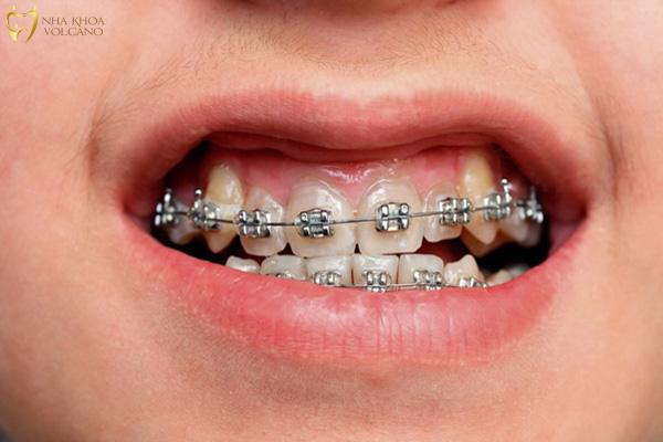 Bật chân răng có nguy hiểm không? Tìm hiểu về tình trạng này Niềng răng bị bật chân răng không chỉ tạo ra vấn đề về thẩm mỹ mà còn mang theo những tác hại nghiêm trọng