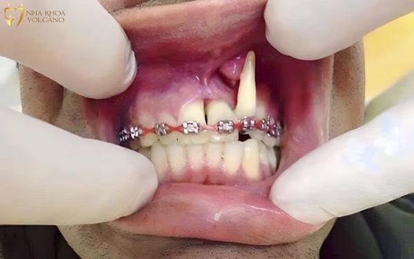 Bật chân răng có nguy hiểm không? Tìm hiểu về tình trạng này Niềng răng là quá trình phức tạp, và bật chân răng có thể xuất phát từ nhiều nguyên nhân