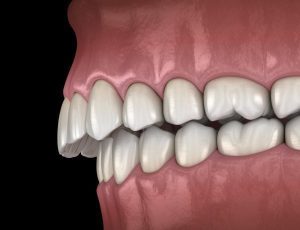 Cách làm răng hết hô tại nhà đơn giản dễ dàng nhất
