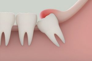 Mọc răng khôn bị sưng má phải làm sao? Giảm đau hiệu quả