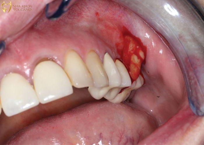 Dị vật và tổn thương trên nướu