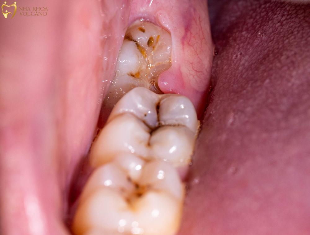 Vì sao mọc răng khôn gây đau nhức, sưng tấy?