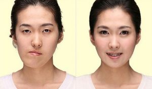 Nhai 1 bên bị lệch mặt và cách khắc phục hậu quả nhanh