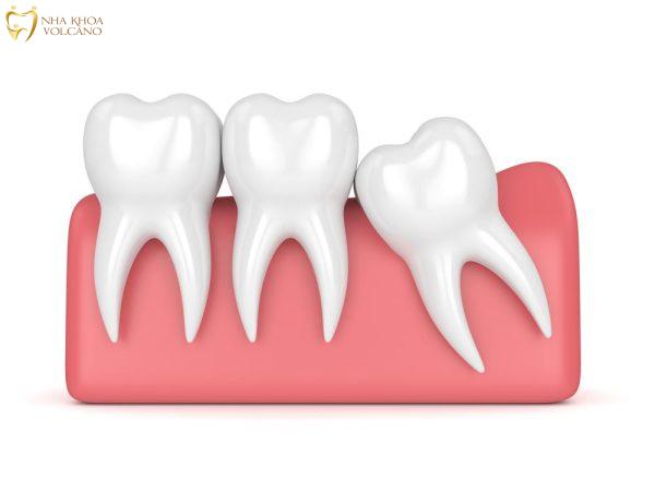 Việc nhổ răng số 8 có nhiều rủi ro và vấn đề có thể xảy ra
