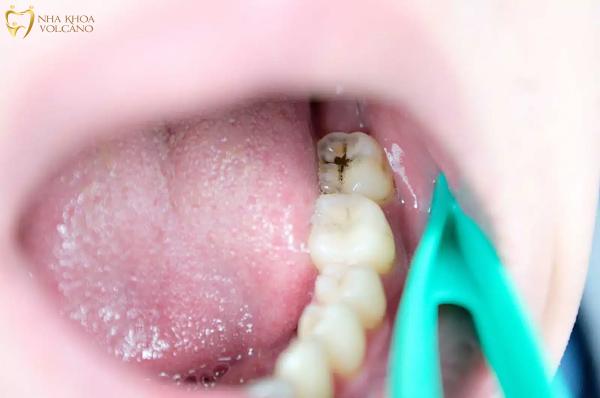 Việc thực hiện biện pháp phòng ngừa và chăm sóc sau khi nhổ răng số 8 là quan trọng