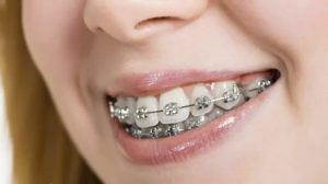 Niềng răng hô mất bao lâu để có kết quả như mong muốn?