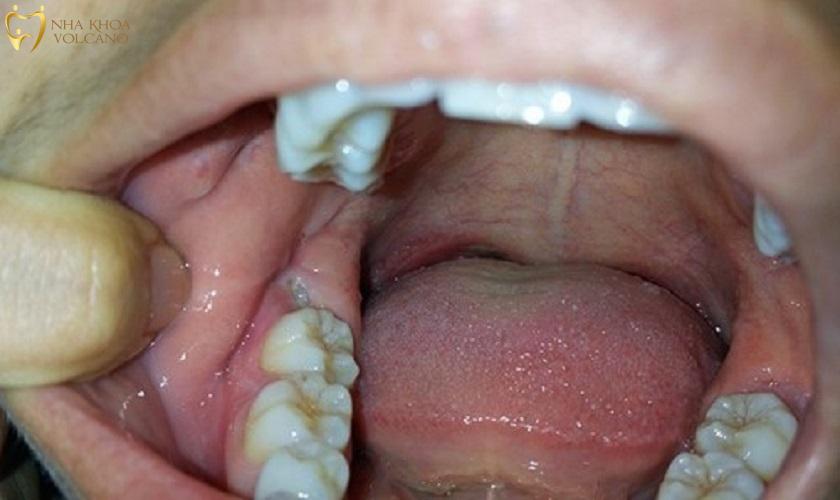 Cách giảm sưng nướu răng trong cùng hàm dưới tại nhà Cách giảm sưng nướu răng trong cùng hàm dưới tại nhà