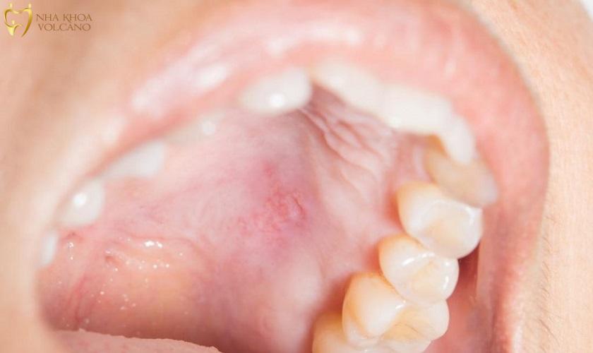Sưng nướu răng trong cùng hàm dưới uống thuốc gì? Sưng nướu răng trong cùng hàm dưới uống thuốc gì?