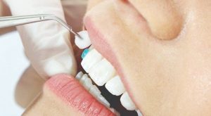 Tháo răng sứ có đau không? Quá trình liệu có đau như nhiều người nghĩ?