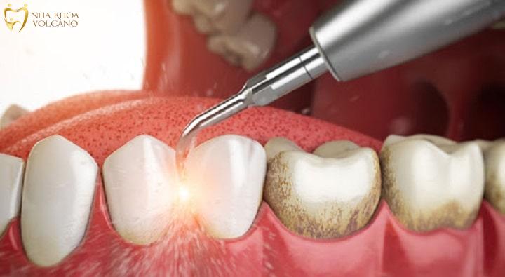 Lấy vôi răng tại Nha Khoa Nụ Cười Xinh Lấy vôi răng tại Nha Khoa Nụ Cười Xinh