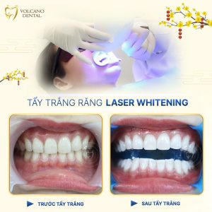 Đồng  - Nha khoa Quốc tế tẩy trắng răng tiết kiệm, an toàn và bền đẹp
