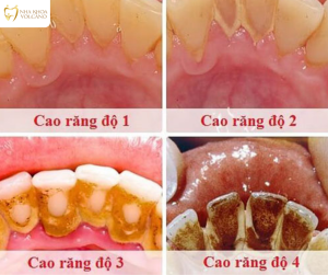 Lấy cao răng