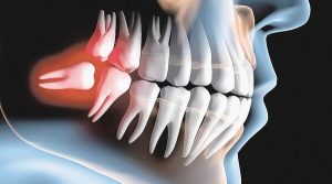 Răng khôn (răng số 8) gây ra nhiều ảnh hưởng đến sức khỏe răng miệng