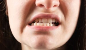Tình trạng bị lệch khớp cắn sau khi được bọc răng sứ