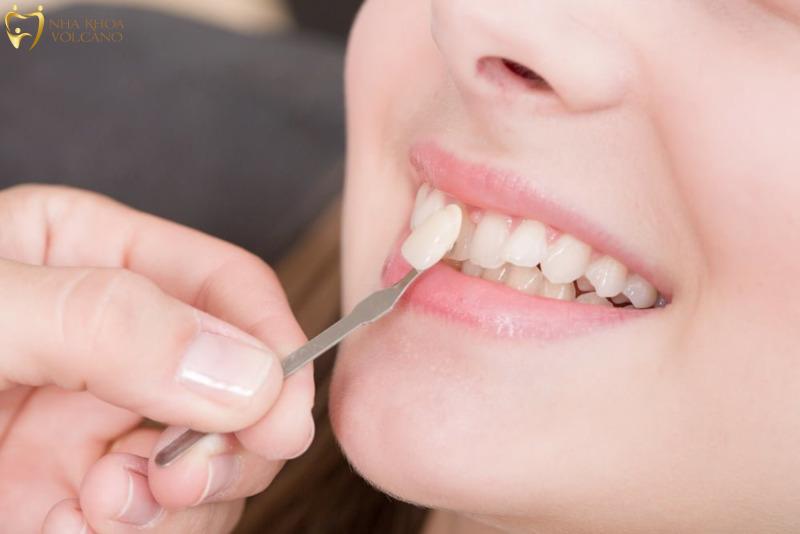 Trước khi phục hình răng sứ, nha sĩ sẽ tiến hành mài một phần men và ngà răng tự nhiên để chuẩn bị trụ răng Trước khi phục hình răng sứ, nha sĩ sẽ tiến hành mài một phần men và ngà răng tự nhiên để chuẩn bị trụ răng
