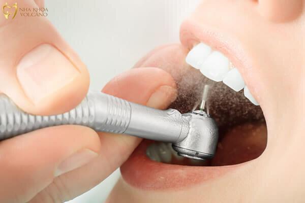 Có nên mài răng cho đều không? Có nên mài răng cho đều không?