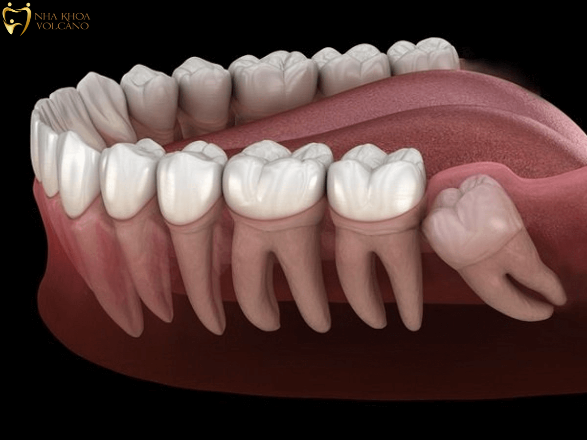 Những biến chứng do đau răng khôn gây ra