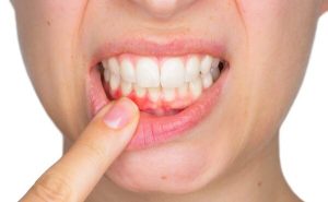 Chấn thương nướu
