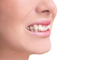 Răng bị lồi hơn so với mức bình thường