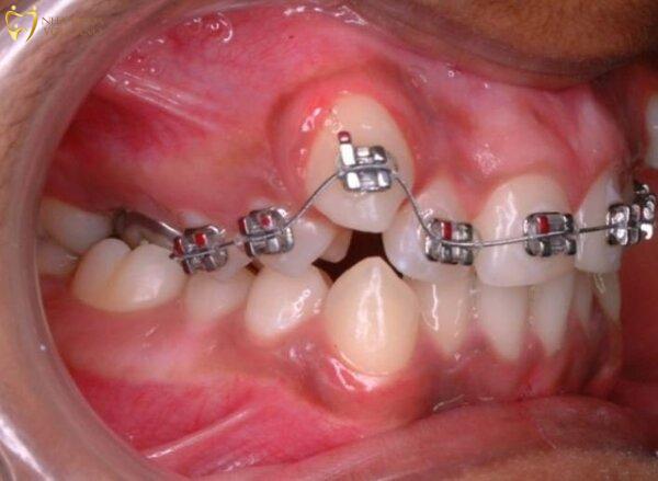 Niềng răng để kéo răng về vị trí mong muốn