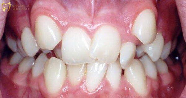 Tình trạng răng lòi xỉ gây ảnh hưởng đến thẩm mỹ của tổng thể khuôn mặt