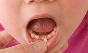 Răng sữa mọc lệch có làm ảnh hưởng răng vĩnh viễn không?