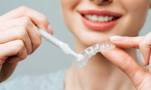 Top thuốc tẩy trắng răng tại nhà hiệu quả nhất