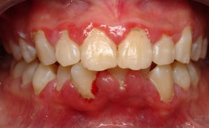 Viêm chân răng có mủ - Dấu hiệu cảnh báo bệnh gì?