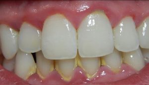 Vôi răng tự tróc có được không? Cách lấy cao răng tại nhà